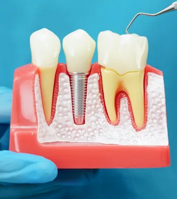 Dental Implants at Southern Prosthodontics in Saltillo, MS