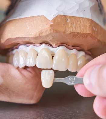 Dental Veneers at Southern Prosthodontics in Saltillo, MS