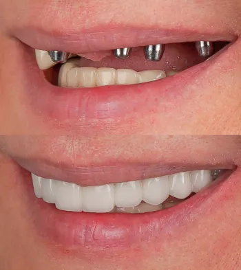 Fixed Hybrid Implants at Southern Prosthodontics in Saltillo, MS