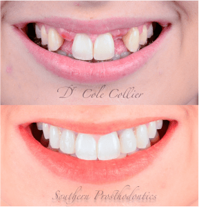 Before and after photos for a prosthodontic procedure