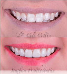 Before and after photos for a prosthodontic procedure